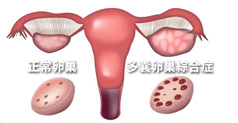 肥胖女性更容易患多囊卵巢综合征吗