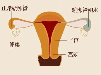 关于输卵管积液你知道多少