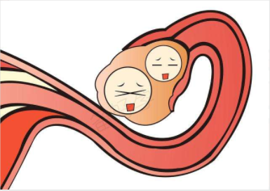 为什么子宫内膜异位症影响生育